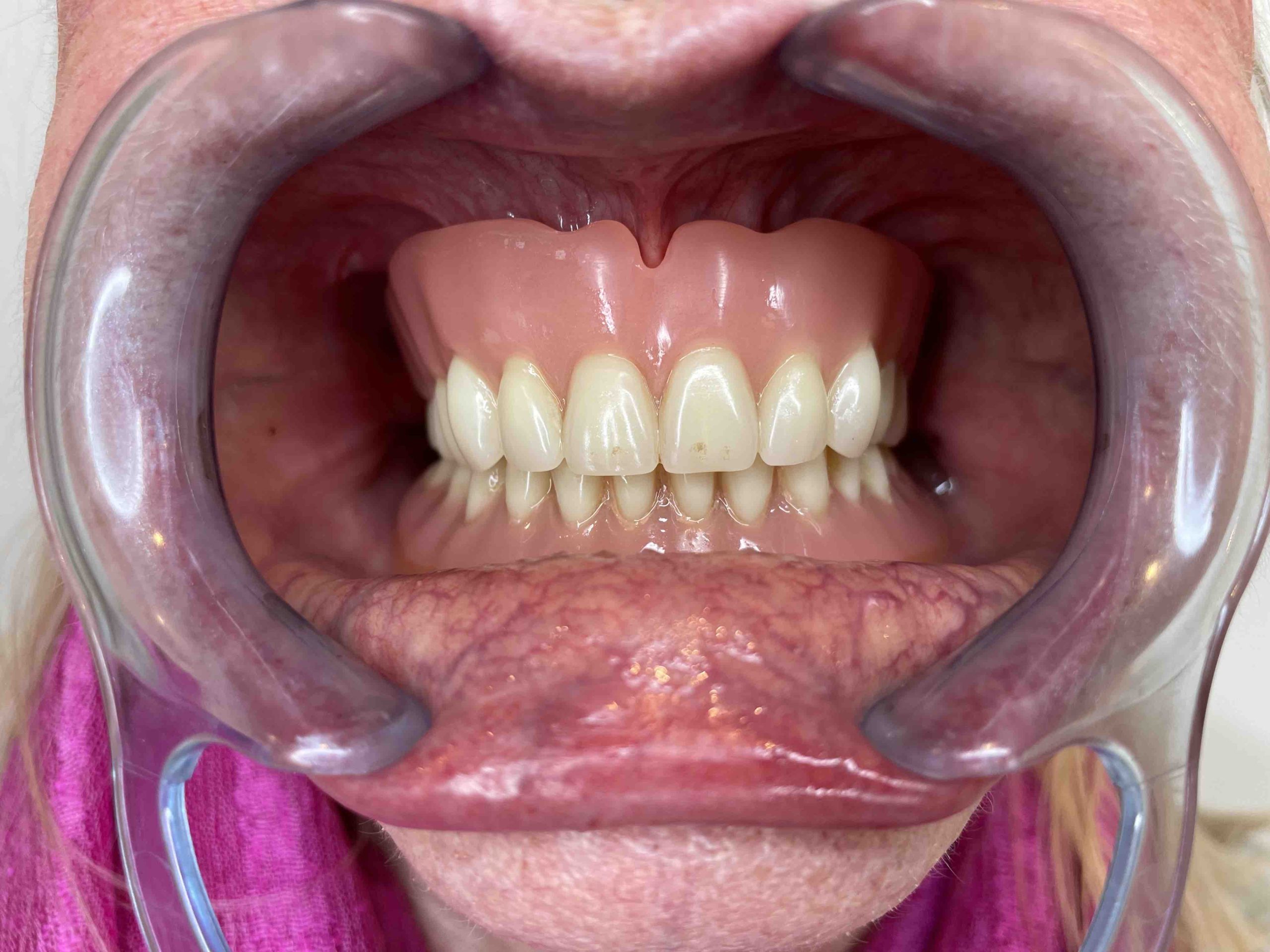 gammel tandprotese åben mund Resultater af færdigeproduceret tandproteser