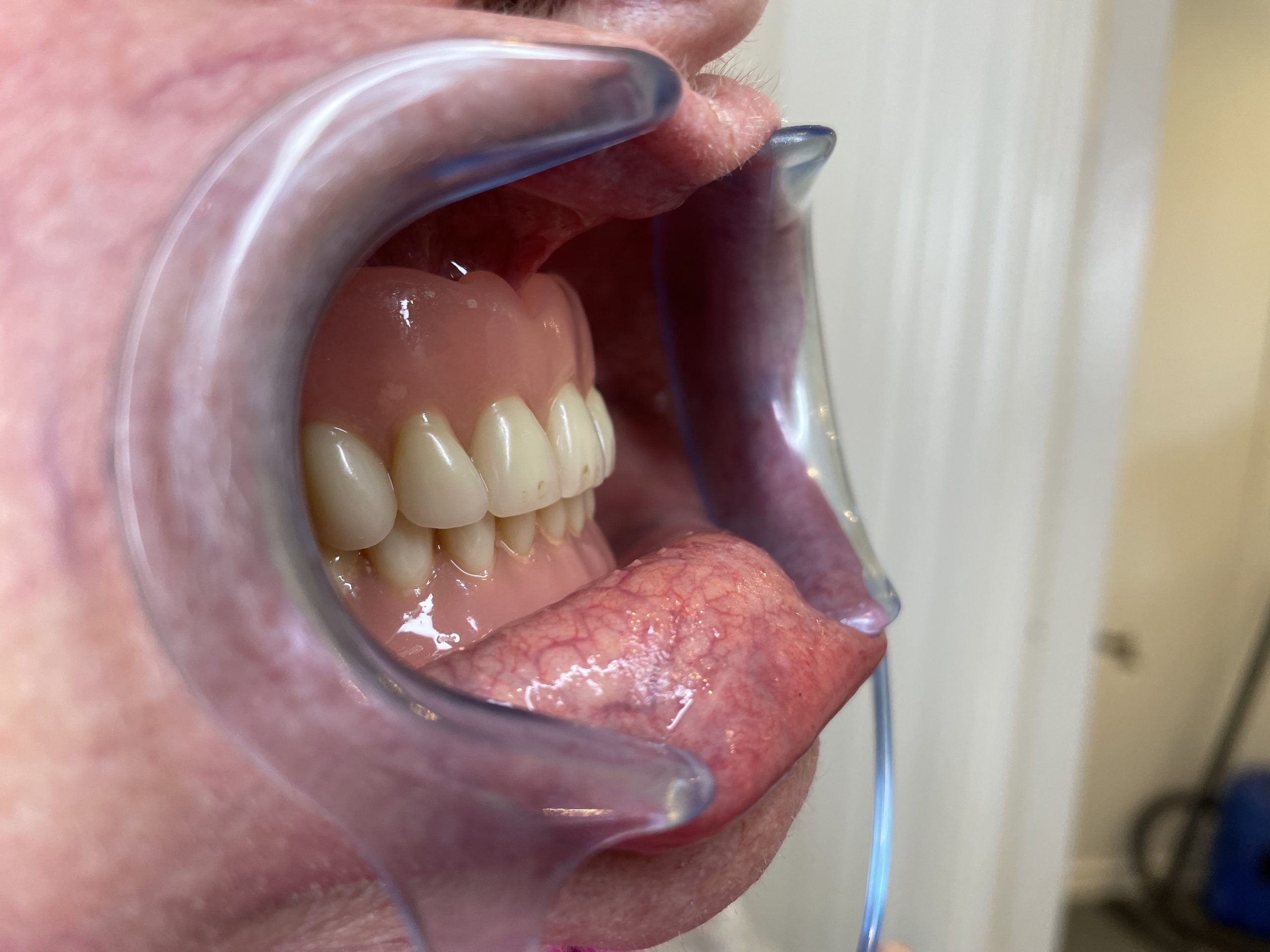 gammel tandprotese højre side åben mund Resultater af færdigeproduceret tandproteser