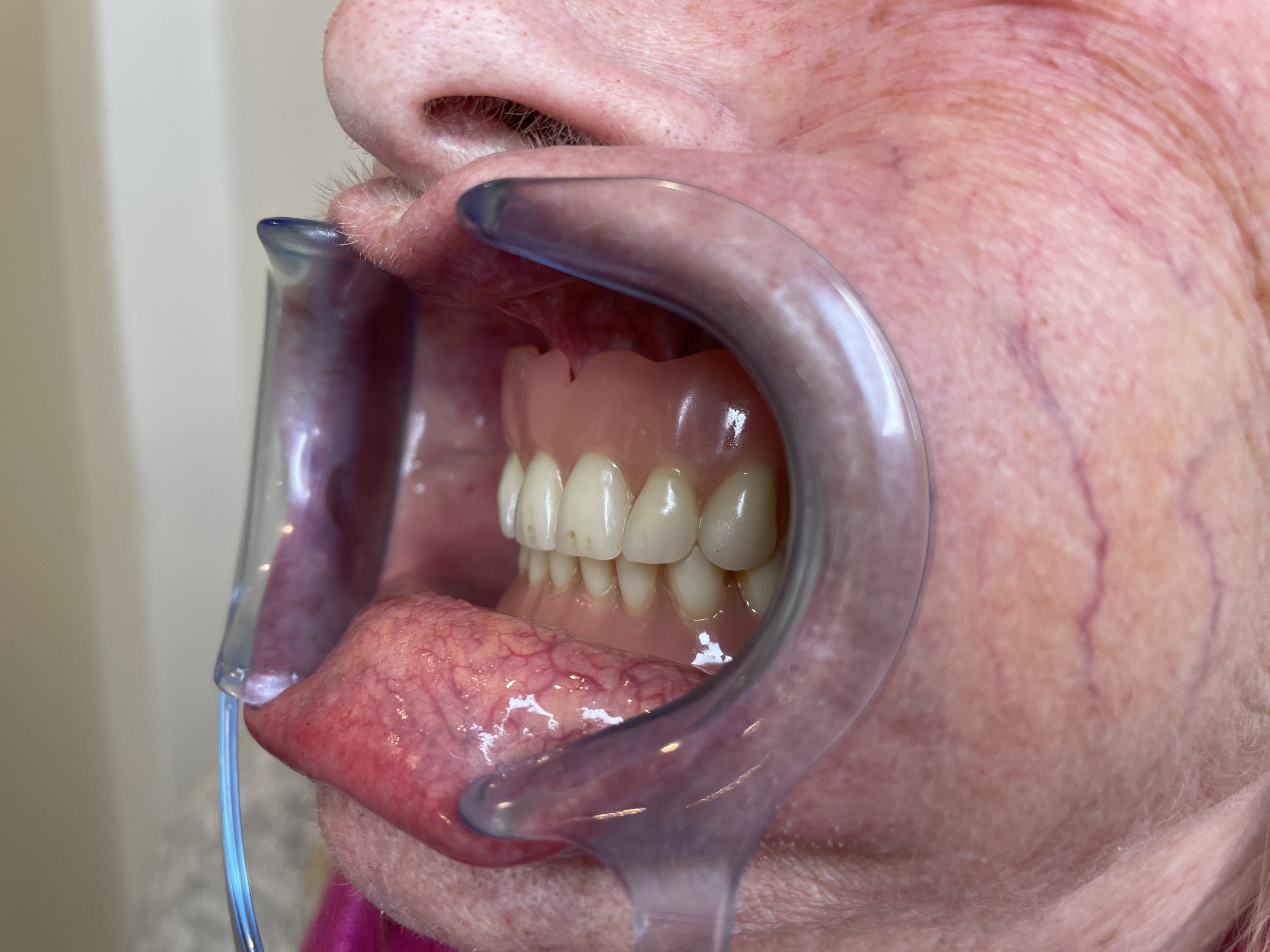 gammel tandprotese åben mund venstre side Resultater af færdigeproduceret tandproteser