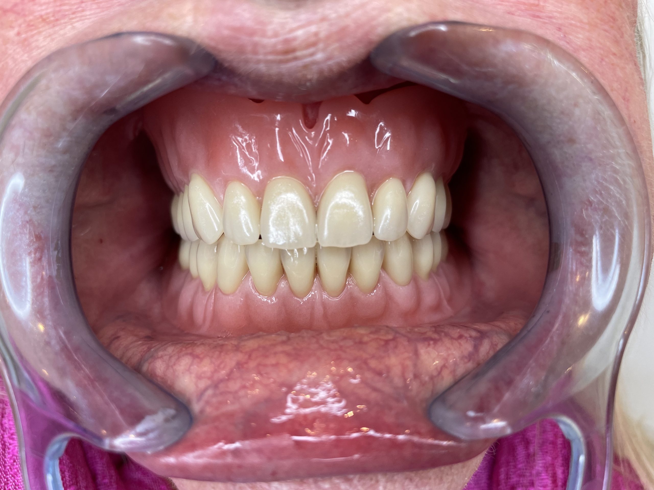 ny tandprotese foran åben mund Resultater af færdigeproduceret tandproteser