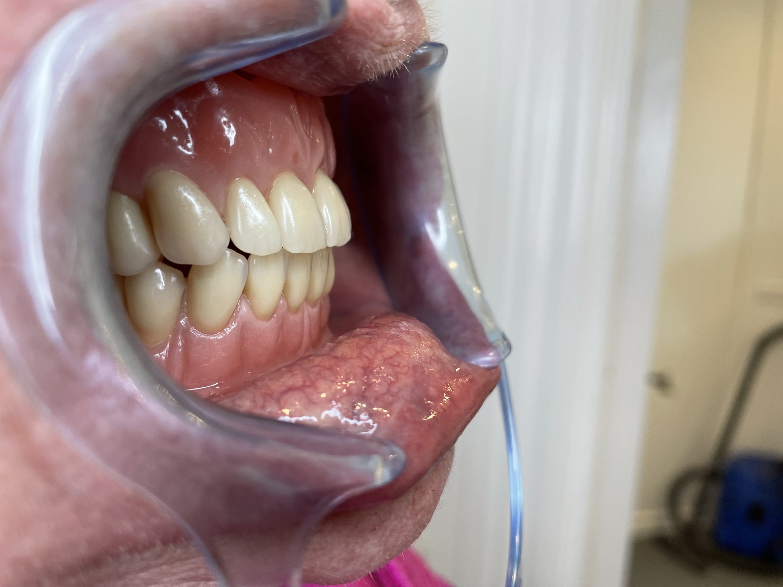 ny tandprotese højre side åben mund Resultater af færdigeproduceret tandproteser