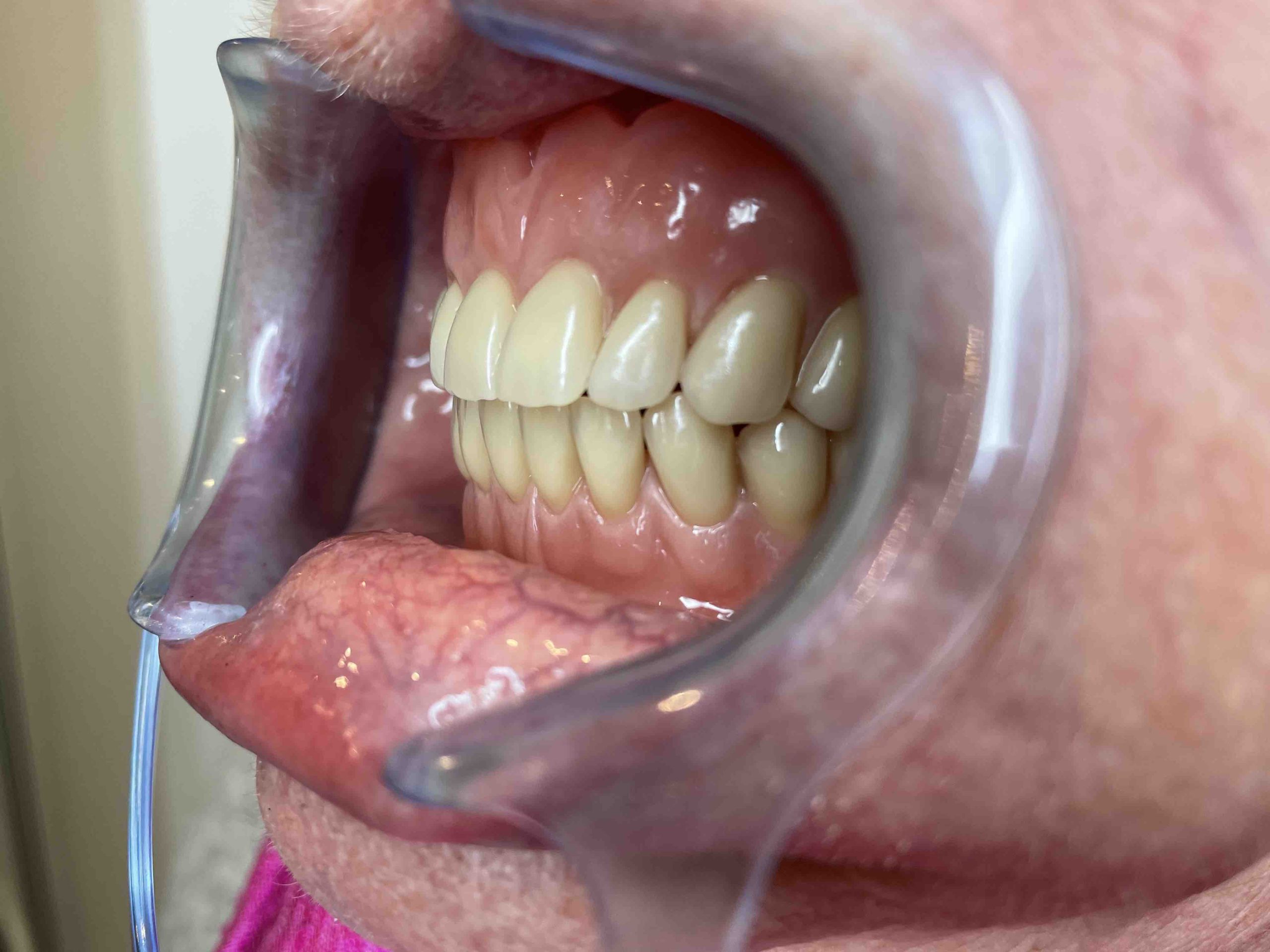ny tandprotese venstre side åben mund Resultater af færdigeproduceret tandproteser