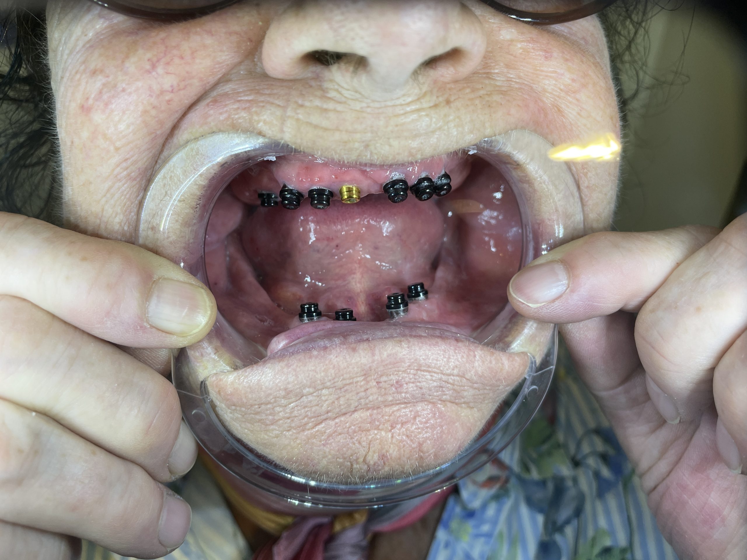 implantat åben mund foran
