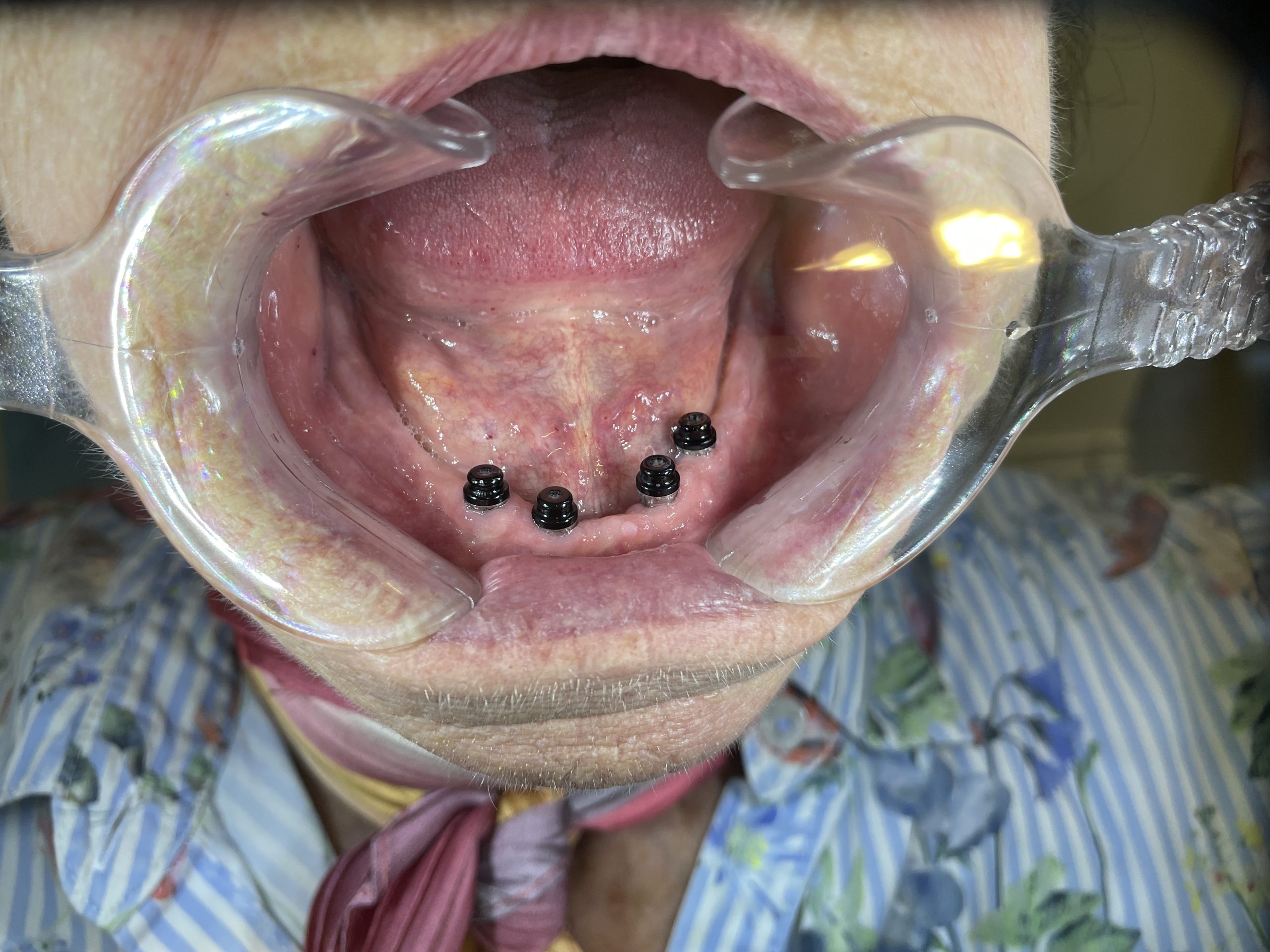 implantat åben undermund