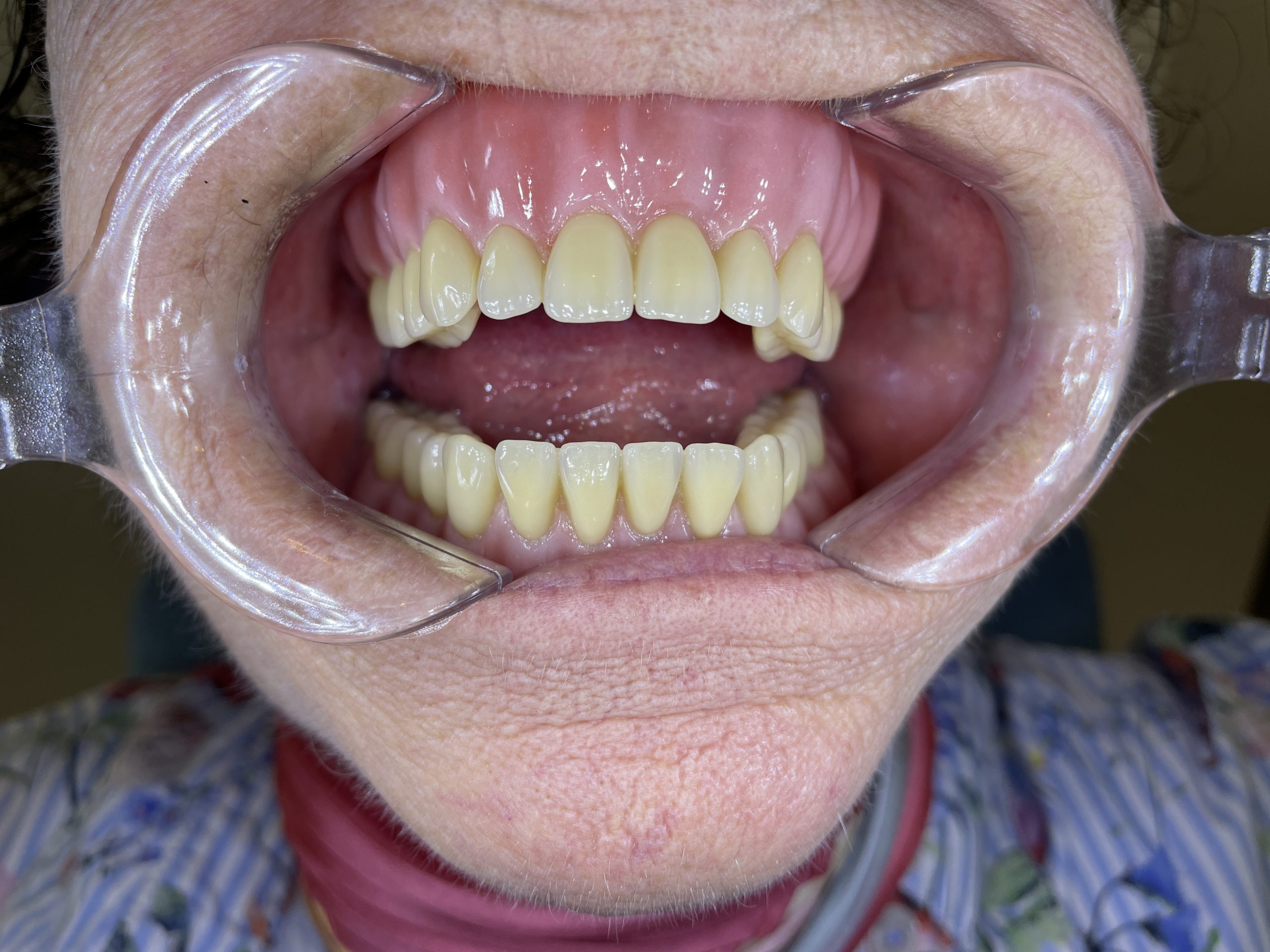 hybrid tandprotese på implantater foran åben mund