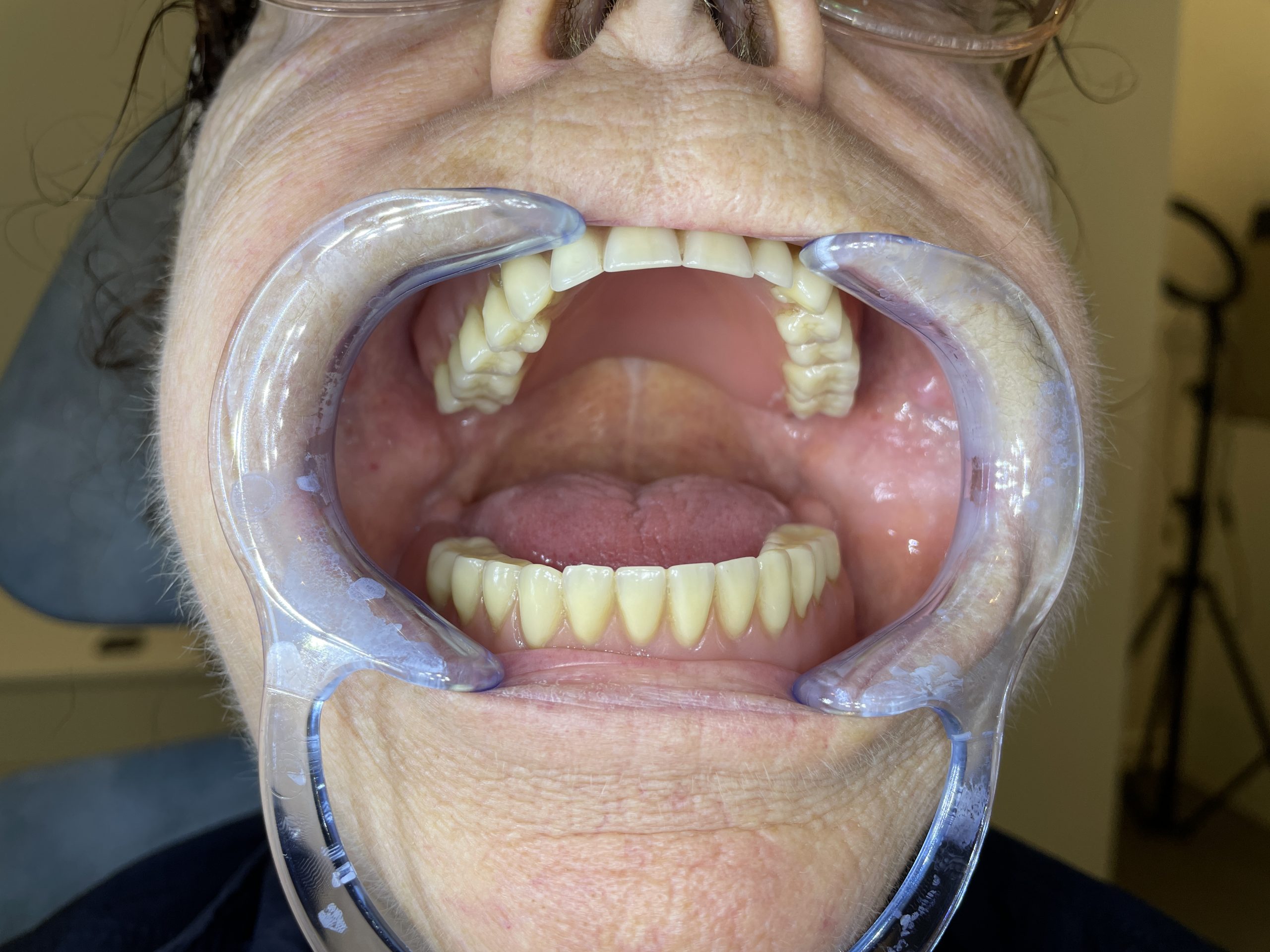gammel tandprotese før hybrid tandprotese foran åben mund
