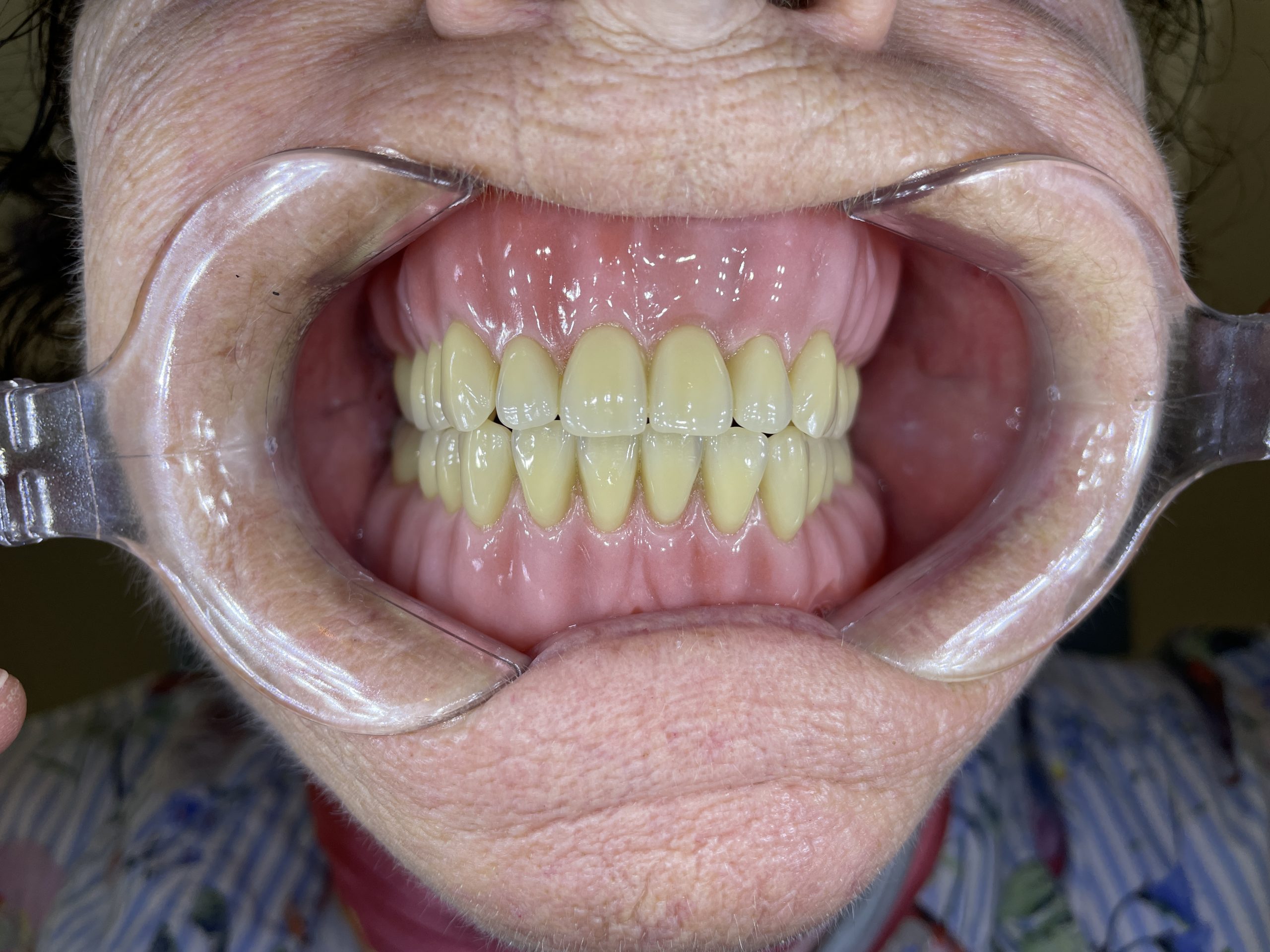 hybrid tandprotese på implantater foran sammenbid