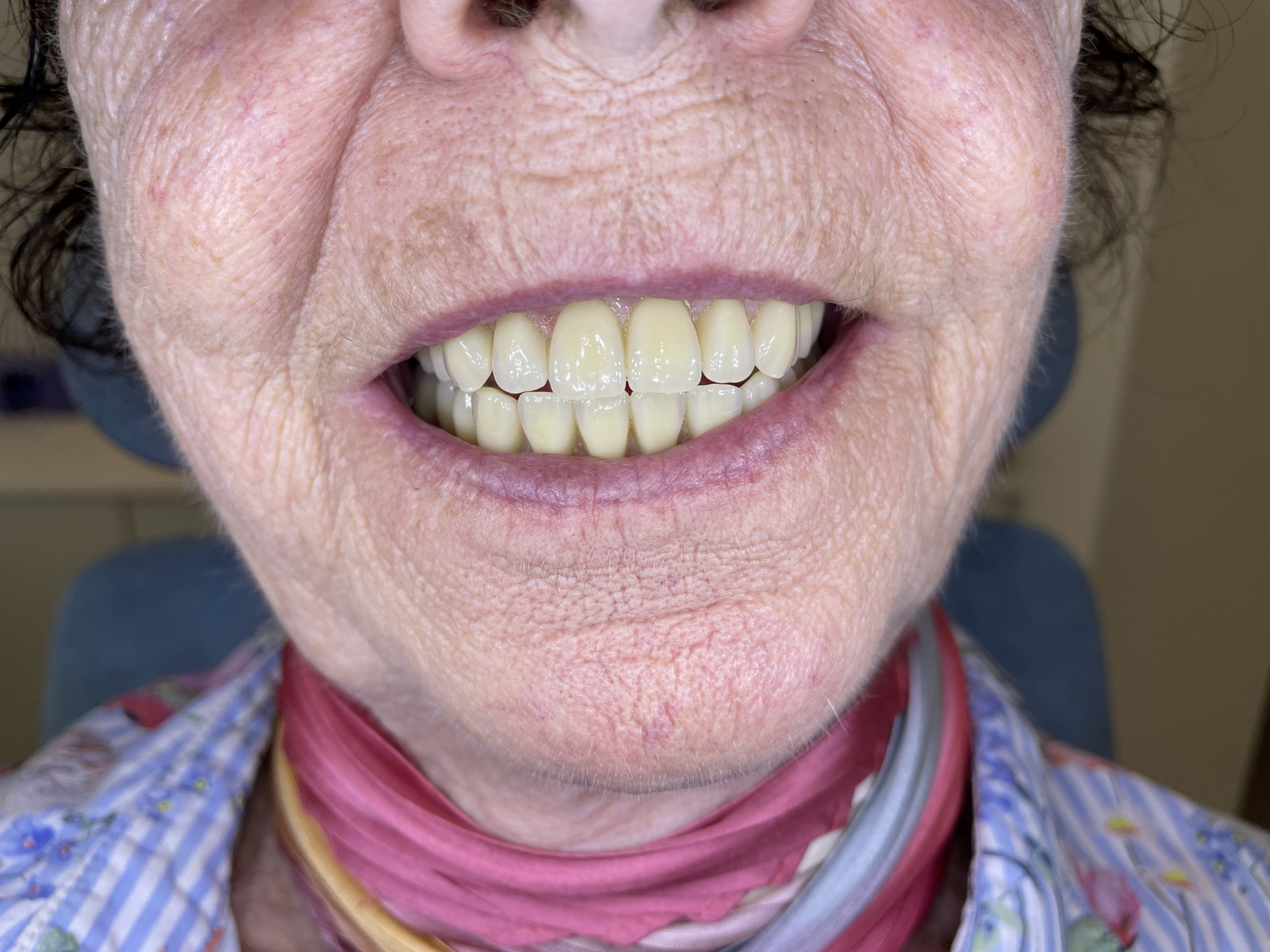 hybrid tandprotese på implantater foran åben mund smiler