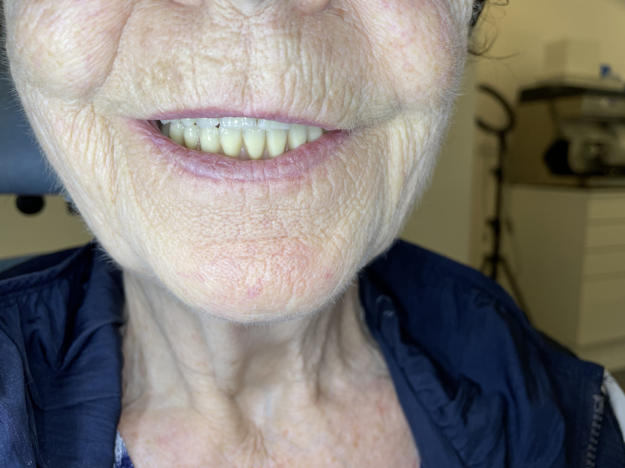 gammel tandprotese før hybrid tandprotese foran smil