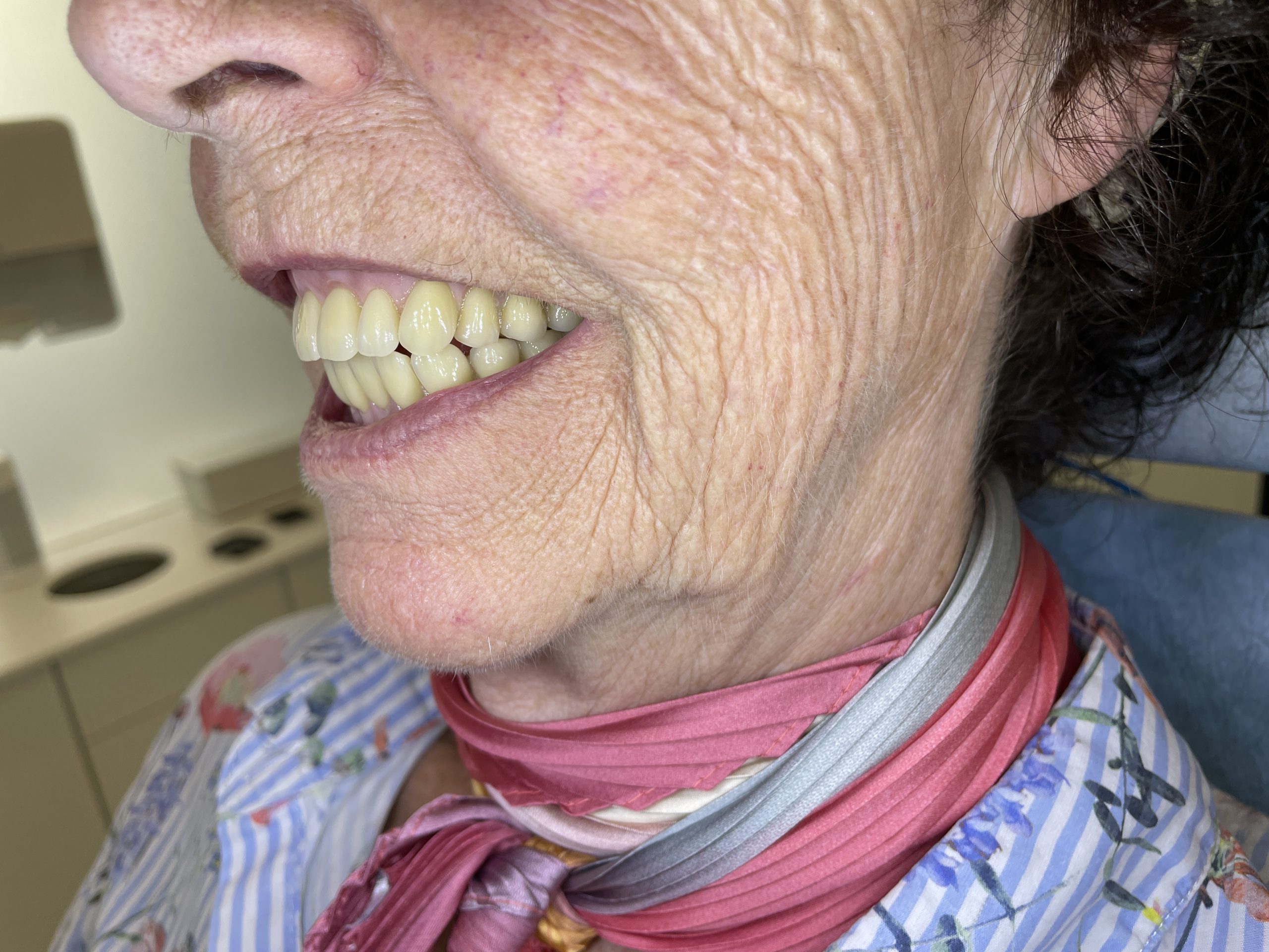 hybrid tandprotese på implantater venstre side smiler